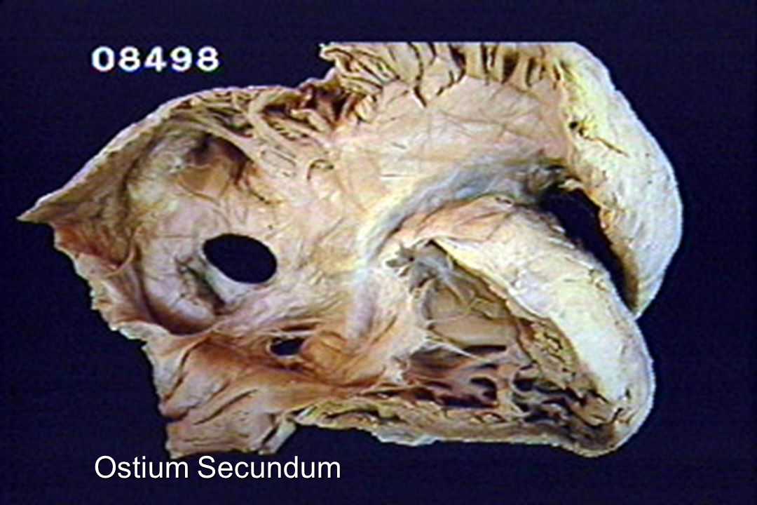 Ostium Secundum