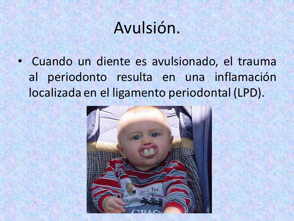Avulsión.