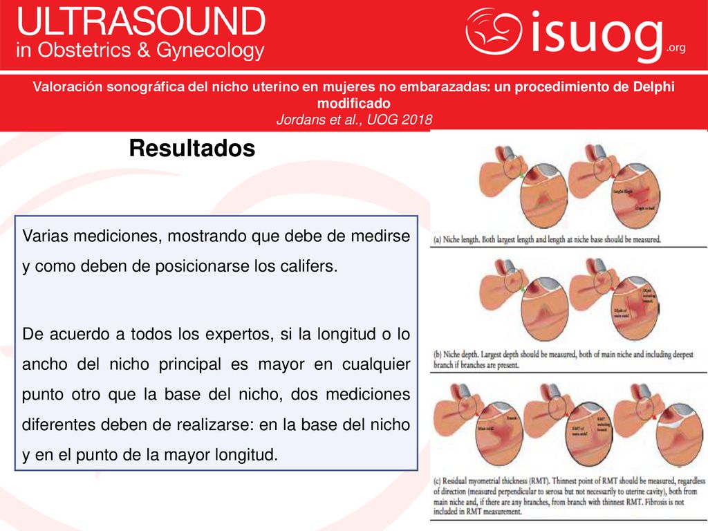 Valoración sonográfica del nicho uterino en mujeres no embarazadas: un procedimiento de Delphi modificado