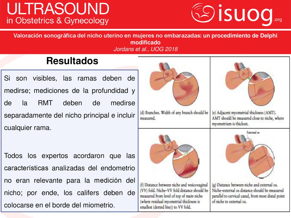 Valoración sonográfica del nicho uterino en mujeres no embarazadas: un procedimiento de Delphi modificado