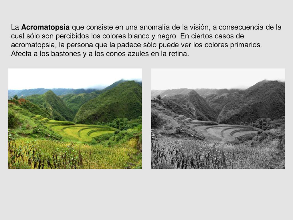 La Acromatopsia que consiste en una anomalía de la visión, a consecuencia de la cual sólo son percibidos los colores blanco y negro.
