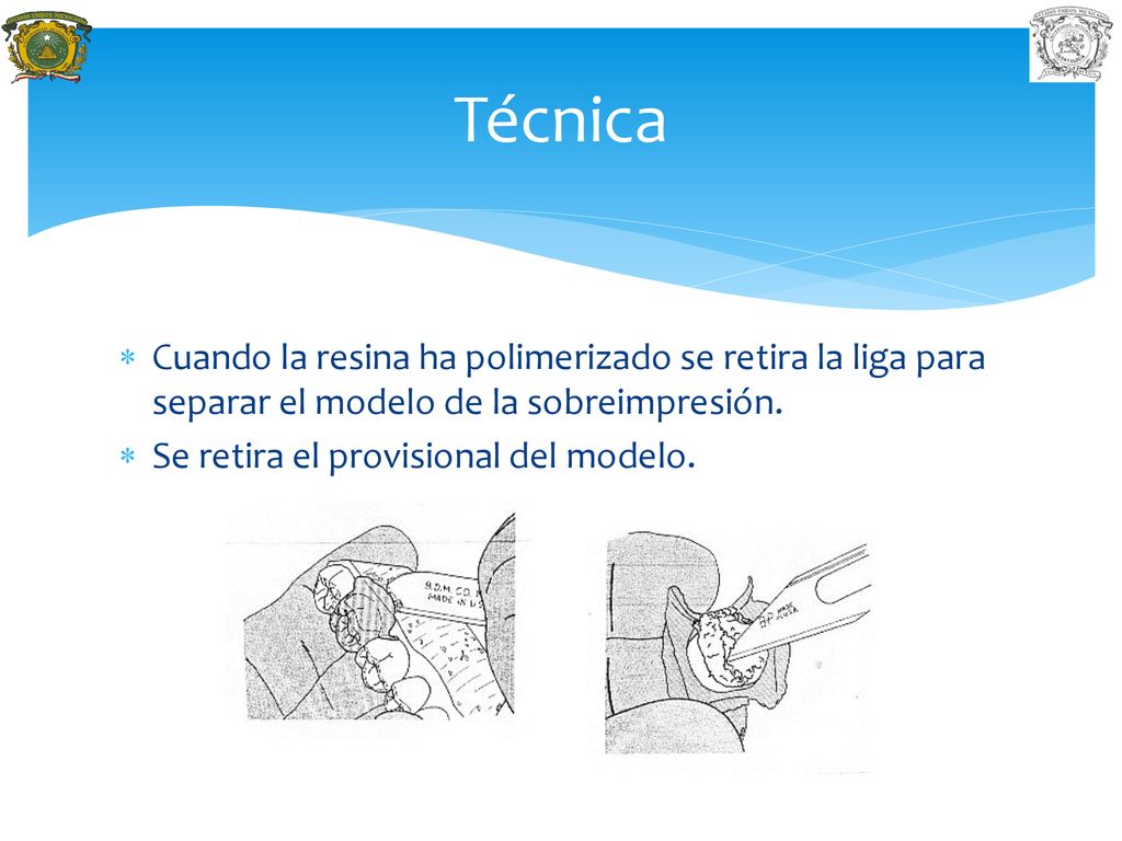 Técnica Cuando la resina ha polimerizado se retira la liga para separar el modelo de la sobreimpresión.