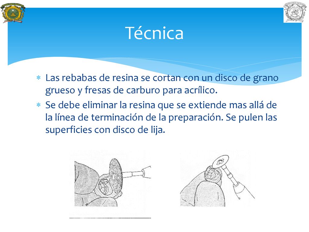 Técnica Las rebabas de resina se cortan con un disco de grano grueso y fresas de carburo para acrílico.