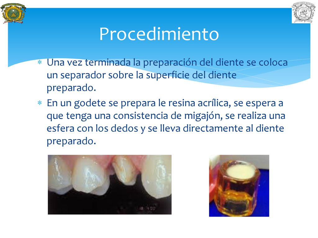 Procedimiento Una vez terminada la preparación del diente se coloca un separador sobre la superficie del diente preparado.