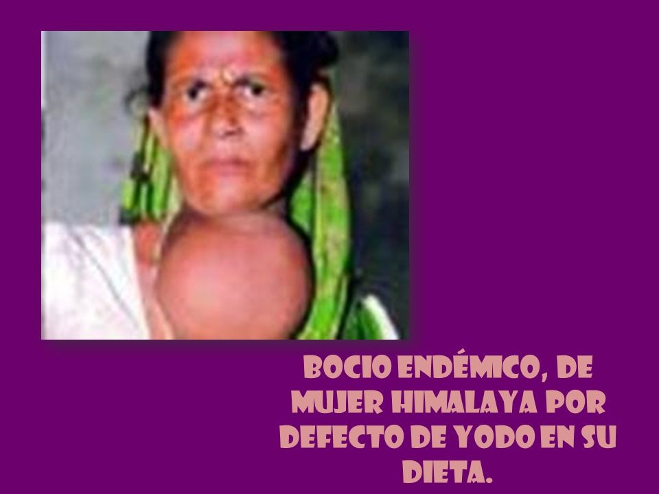 Bocio endémico, de mujer Himalaya por defecto de yodo en su dieta.