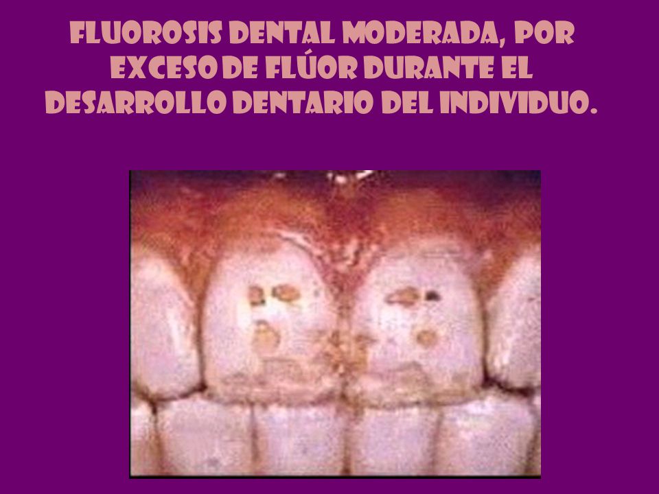 FLUOROSIS DENTAL MODERADA, POR EXCESO DE FLÚOR DURANTE EL DESARROLLO DENTARIO DEL INDIVIDUO.