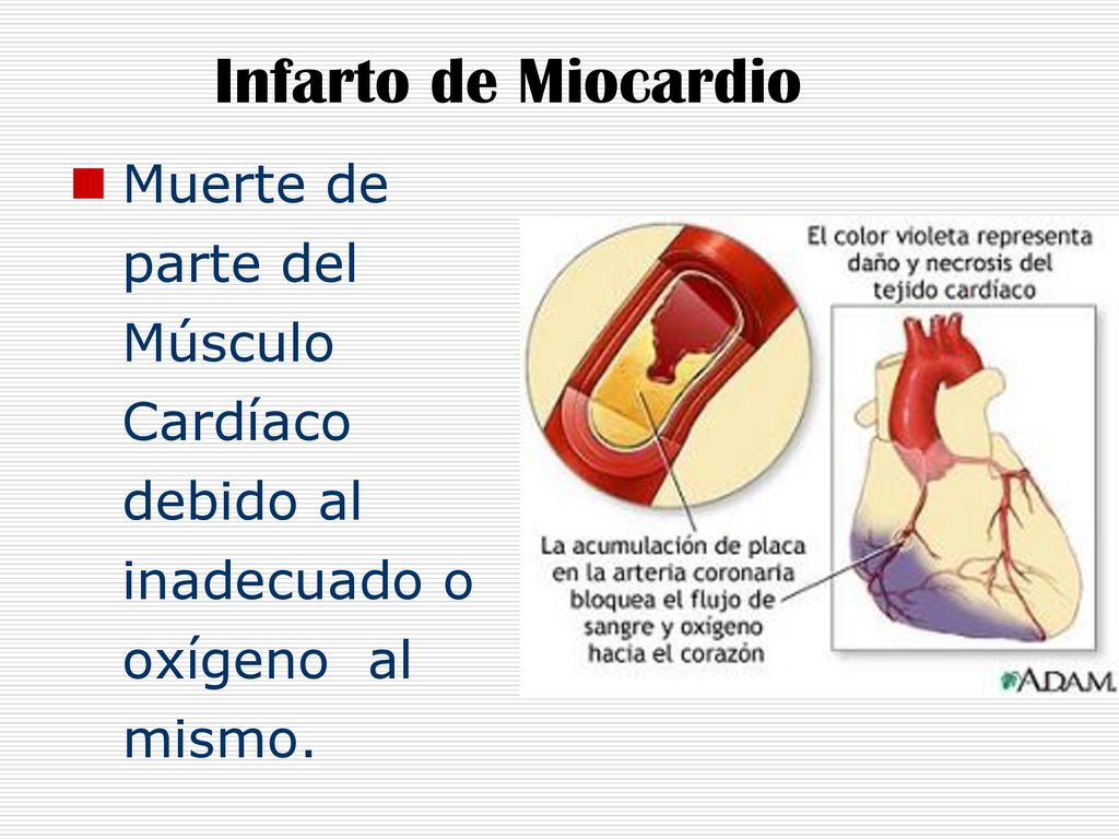Infarto de Miocardio Muerte de parte del Músculo Cardíaco debido al inadecuado o oxígeno al mismo.