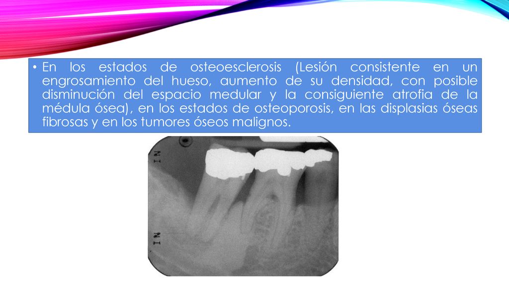 En los estados de osteoesclerosis (Lesión consistente en un engrosamiento del hueso, aumento de su densidad, con posible disminución del espacio medular y la consiguiente atrofia de la médula ósea), en los estados de osteoporosis, en las displasias óseas fibrosas y en los tumores óseos malignos.