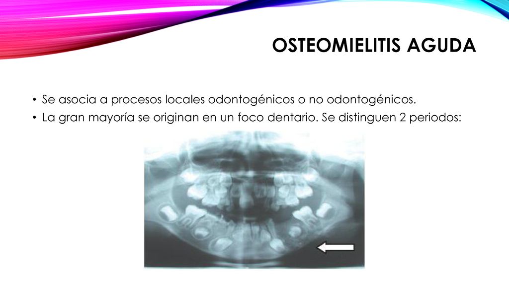 Osteomielitis aguda Se asocia a procesos locales odontogénicos o no odontogénicos.