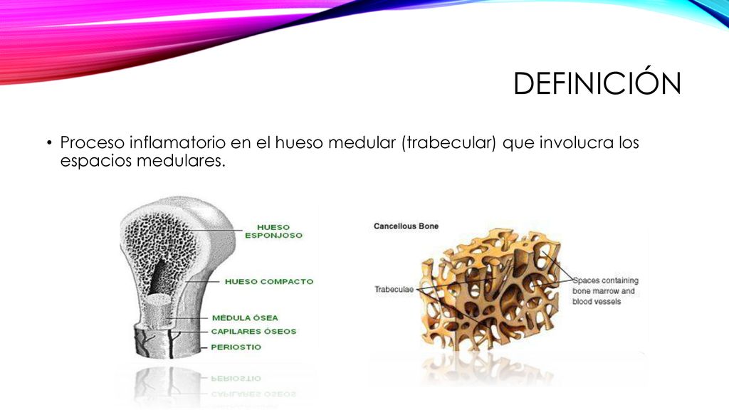 definición Proceso inflamatorio en el hueso medular (trabecular) que involucra los espacios medulares.