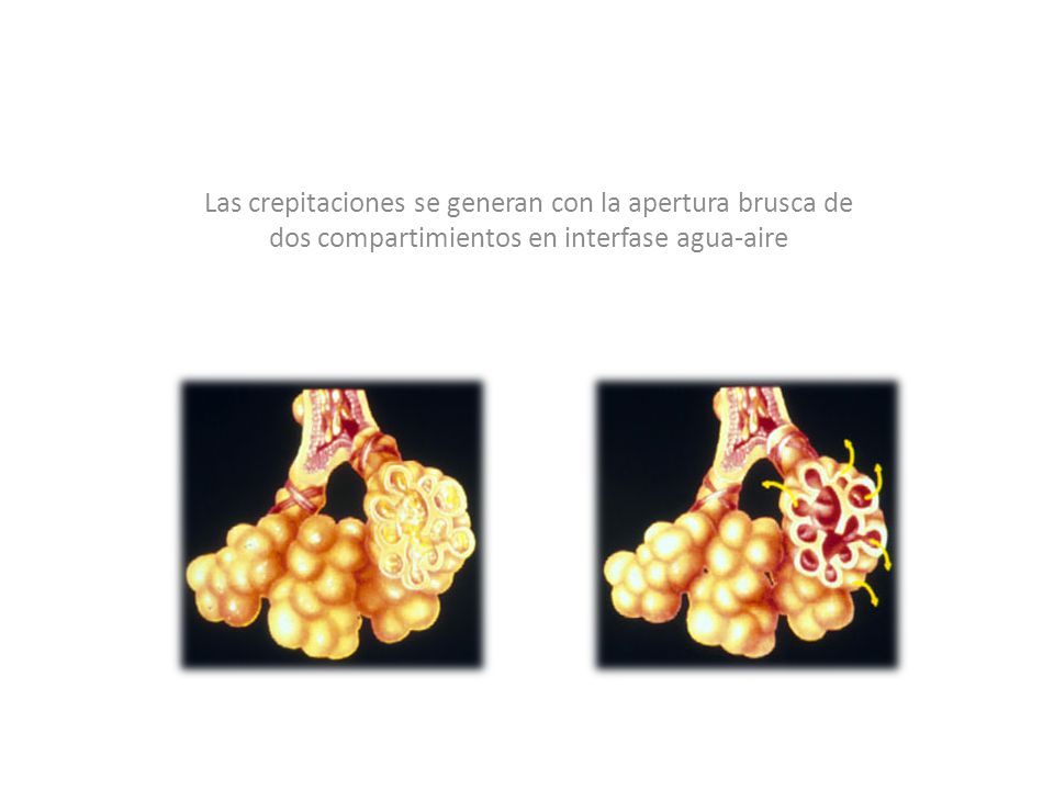 Las crepitaciones se generan con la apertura brusca de dos compartimientos en interfase agua-aire