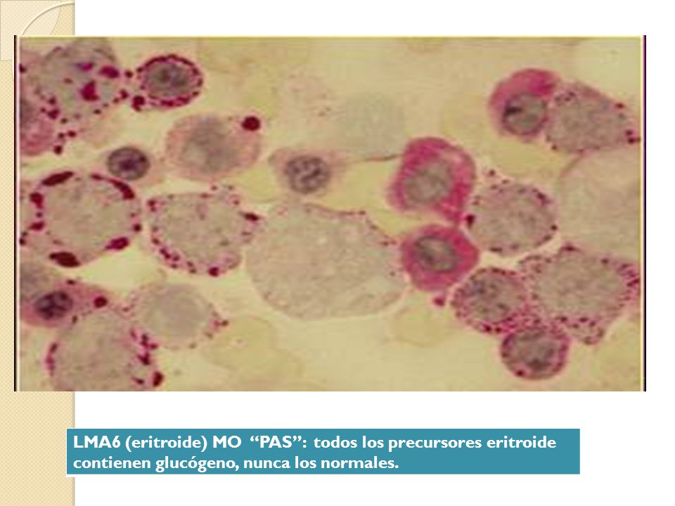 LMA6 (eritroide) MO PAS : todos los precursores eritroide contienen glucógeno, nunca los normales.