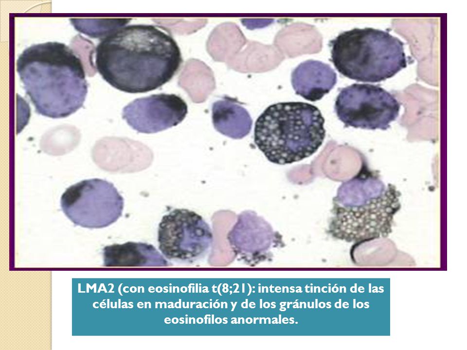 LMA2 (con eosinofilia t(8;21): intensa tinción de las células en maduración y de los gránulos de los eosinofilos anormales.