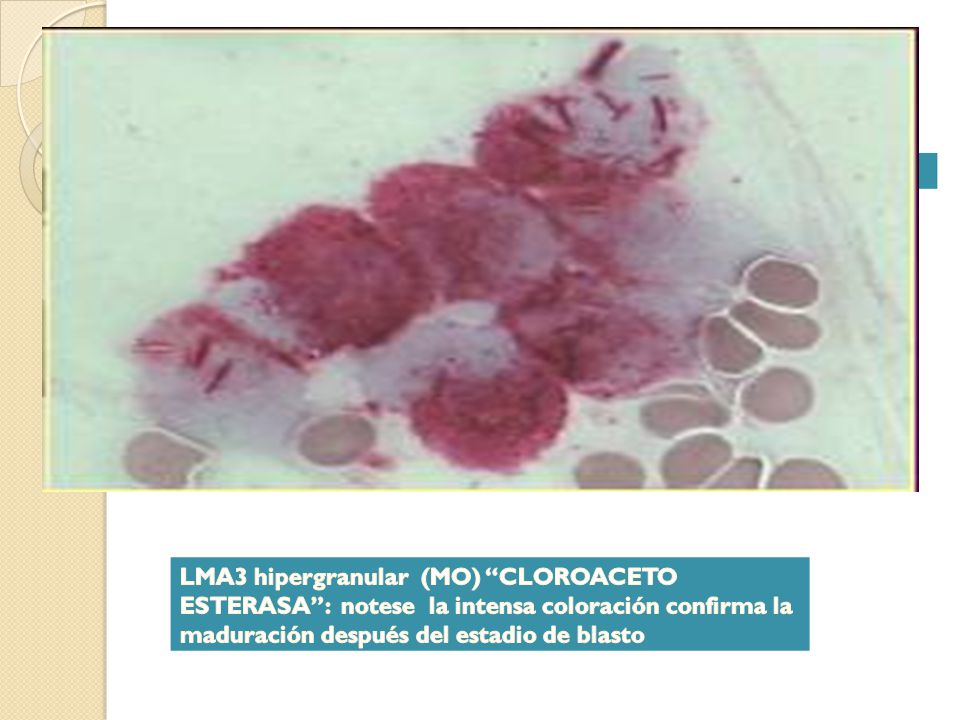LMA3 hipergranular (MO) CLOROACETO ESTERASA : notese la intensa coloración confirma la maduración después del estadio de blasto