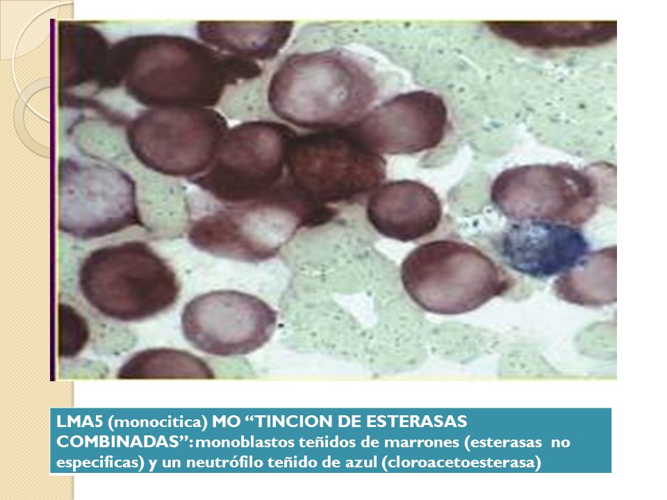 LMA5 (monocitica) MO TINCION DE ESTERASAS COMBINADAS : monoblastos teñidos de marrones (esterasas no especificas) y un neutrófilo teñido de azul (cloroacetoesterasa)