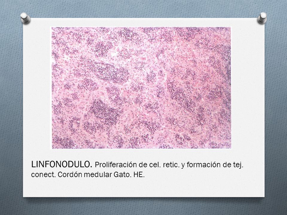 LINFONODULO. Proliferación de cel. retic. y formación de tej. conect