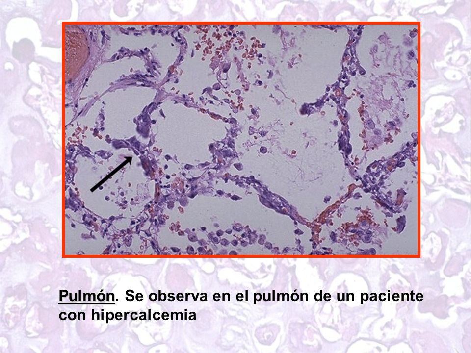 Pulmón. Se observa en el pulmón de un paciente con hipercalcemia