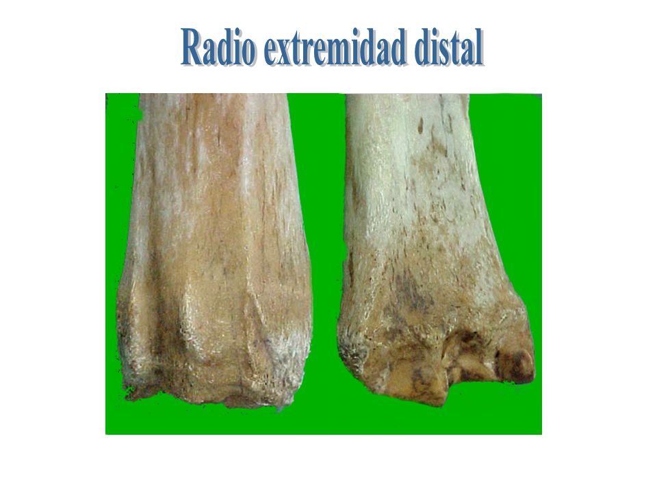 Radio extremidad distal
