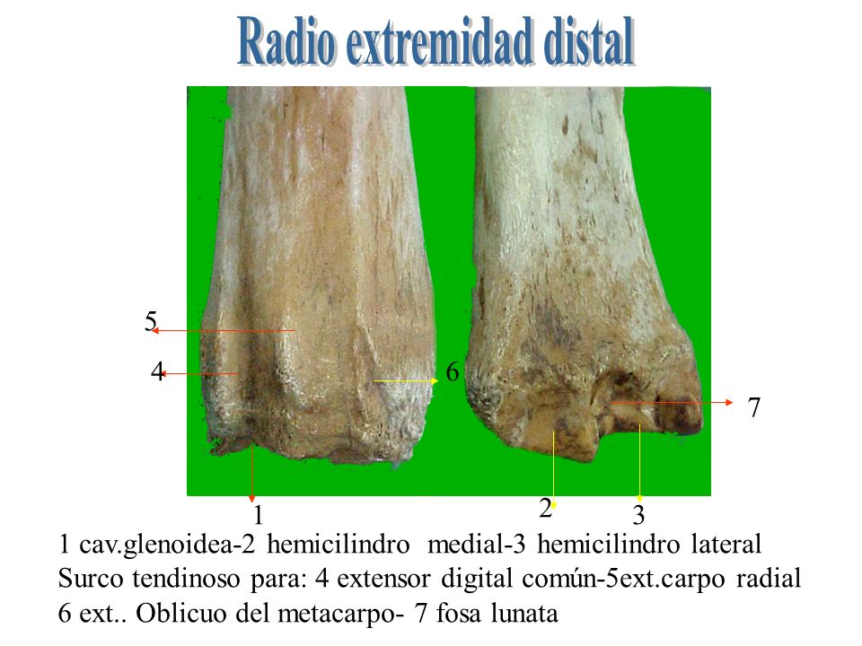 Radio extremidad distal