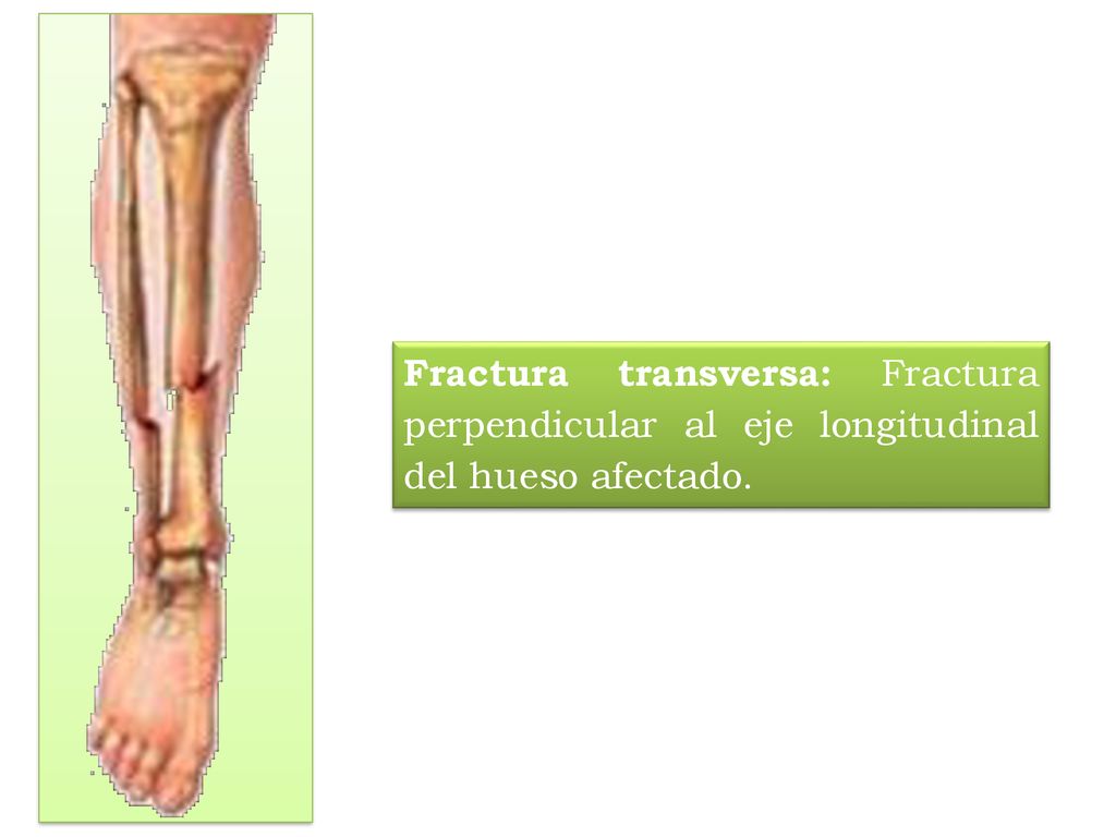 Fractura transversa: Fractura perpendicular al eje longitudinal del hueso afectado.