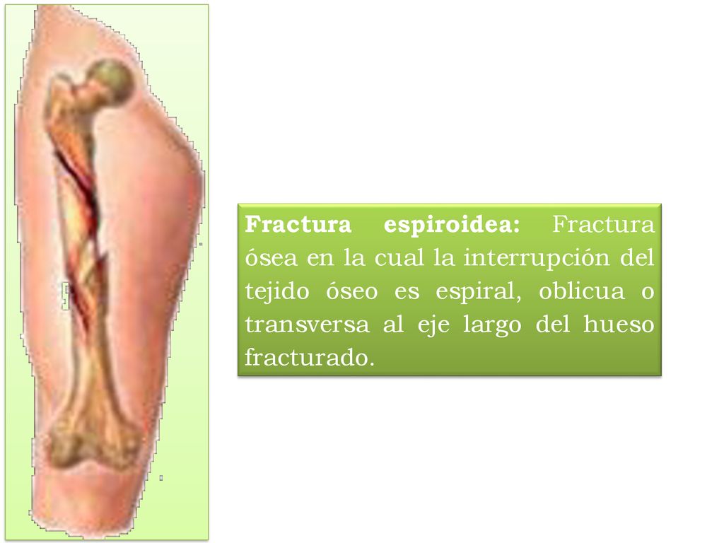 Fractura espiroidea: Fractura ósea en la cual la interrupción del tejido óseo es espiral, oblicua o transversa al eje largo del hueso fracturado.