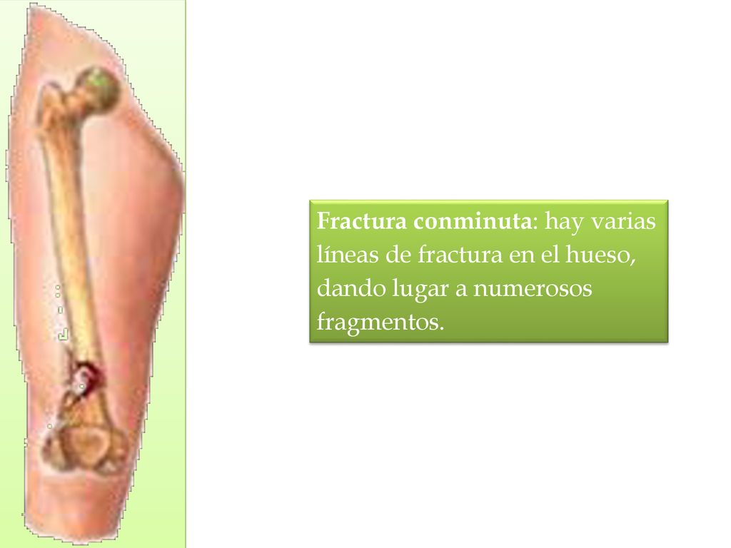 Fractura conminuta: hay varias líneas de fractura en el hueso, dando lugar a numerosos fragmentos.