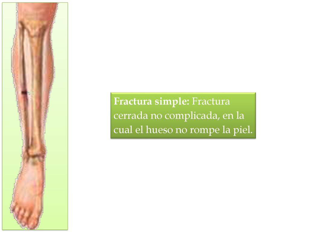 Fractura simple: Fractura cerrada no complicada, en la cual el hueso no rompe la piel.