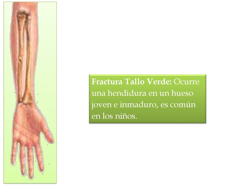 Fractura Tallo Verde: Ocurre una hendidura en un hueso joven e inmaduro, es común en los niños.