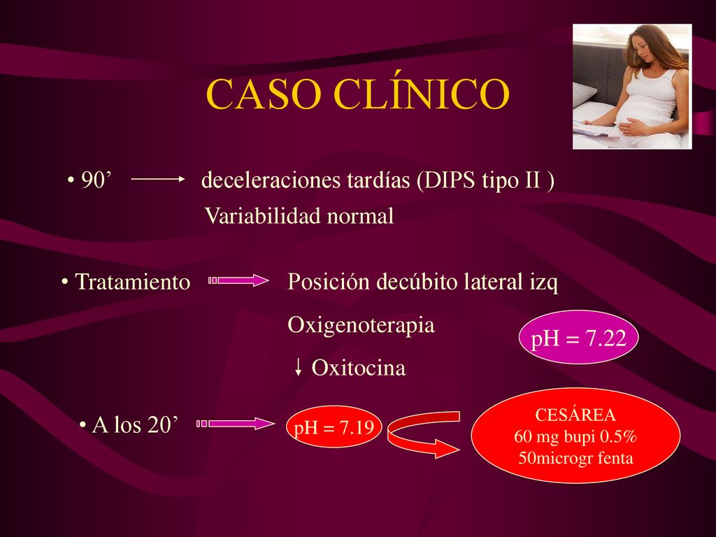 CASO CLÍNICO 90’ deceleraciones tardías (DIPS tipo II )
