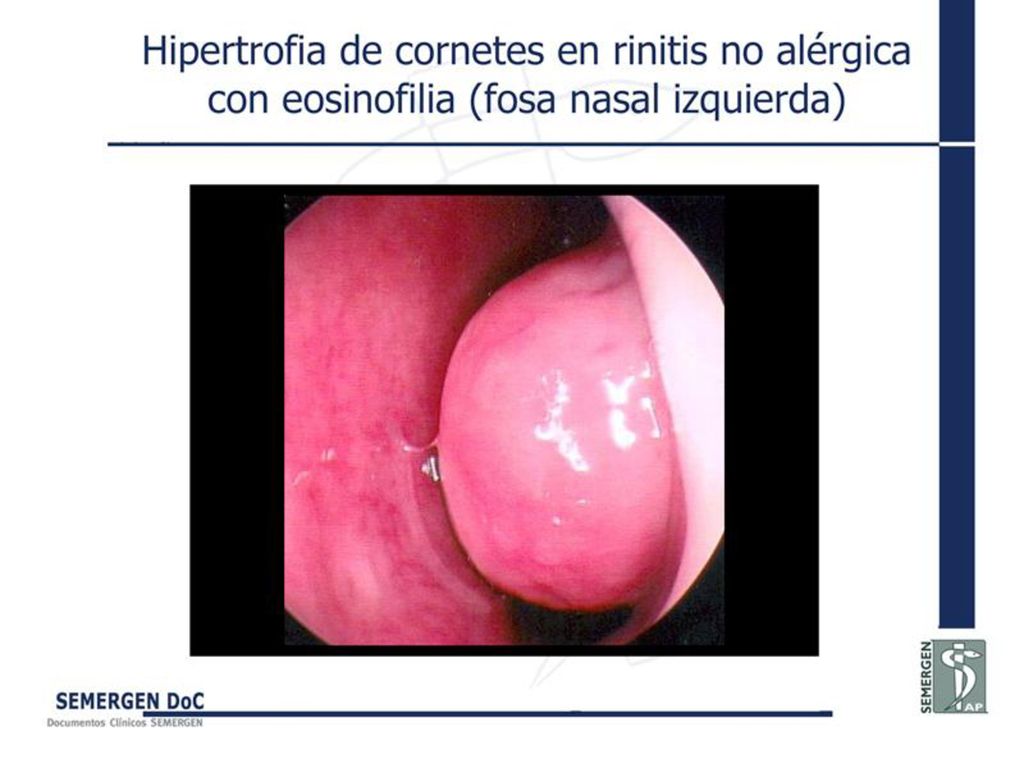 Hipertrofia de cornetes en rinitis no alérgica con eosinofilia (fosa nasal izquierda)
