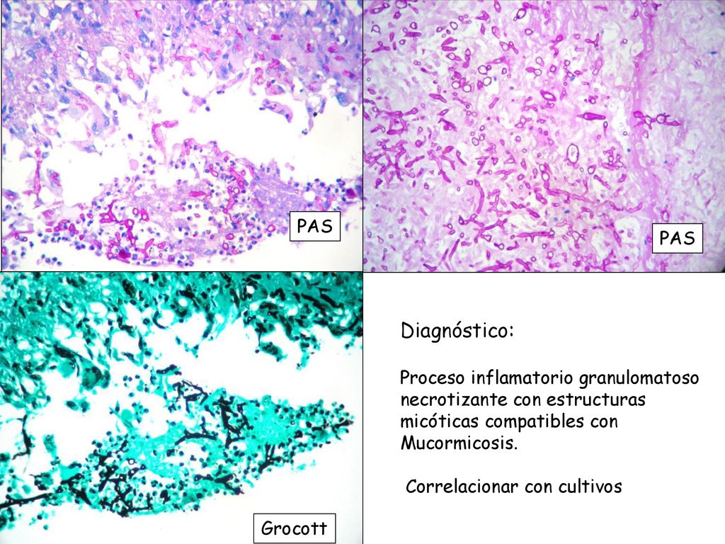 PAS PAS. Diagnóstico: Proceso inflamatorio granulomatoso necrotizante con estructuras micóticas compatibles con Mucormicosis.