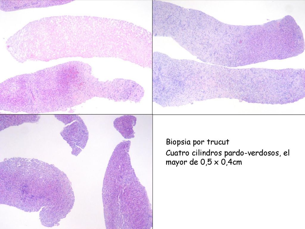 Biopsia por trucut Cuatro cilindros pardo-verdosos, el mayor de 0,5 x 0,4cm