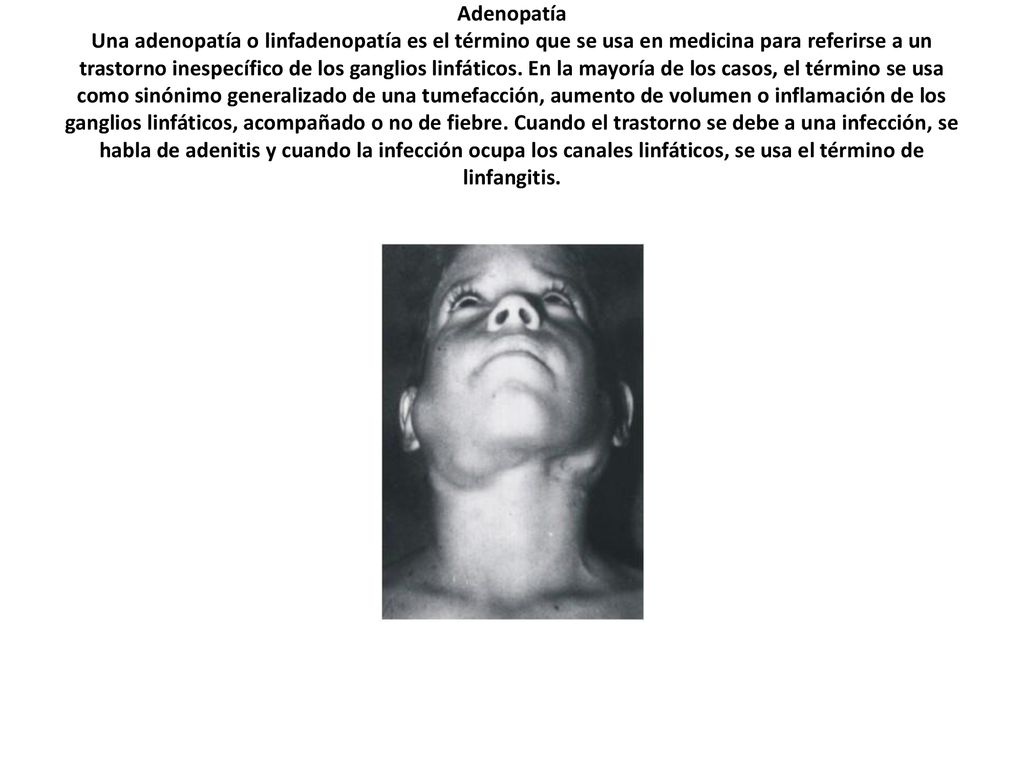 Adenopatía Una adenopatía o linfadenopatía es el término que se usa en medicina para referirse a un trastorno inespecífico de los ganglios linfáticos.