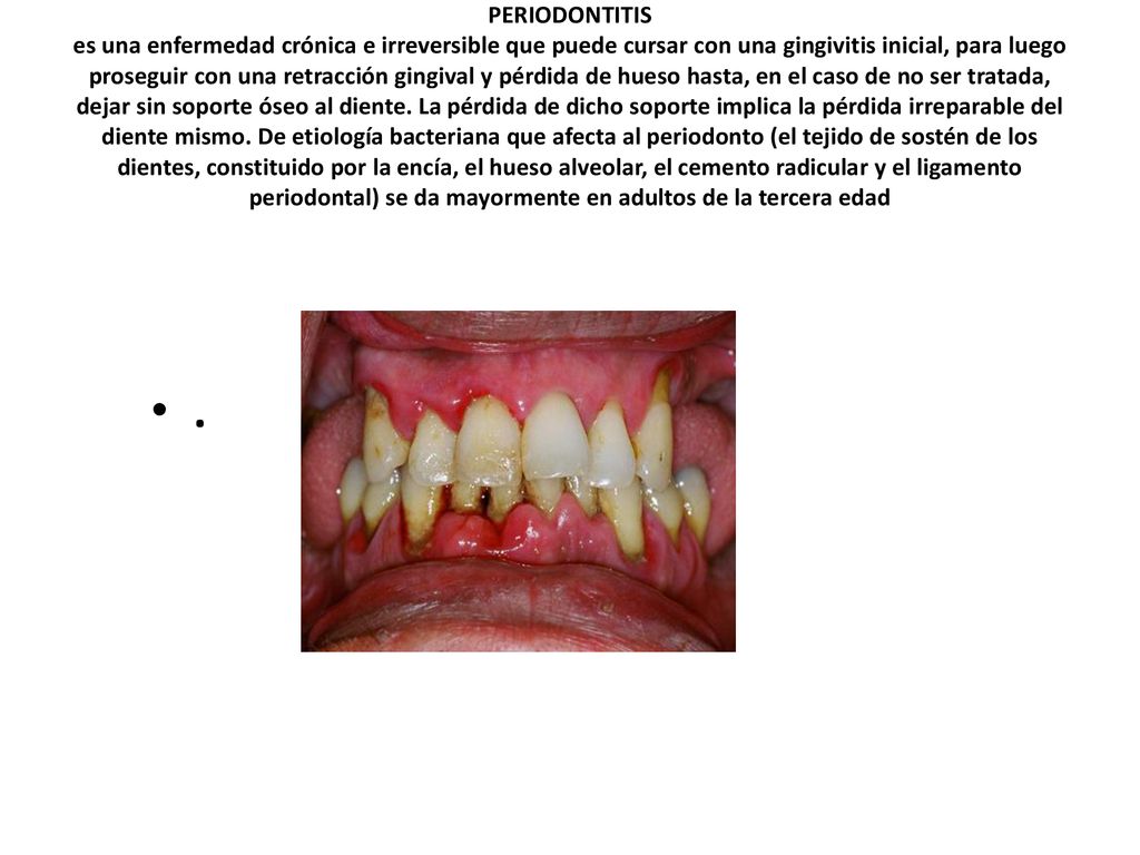 PERIODONTITIS es una enfermedad crónica e irreversible que puede cursar con una gingivitis inicial, para luego proseguir con una retracción gingival y pérdida de hueso hasta, en el caso de no ser tratada, dejar sin soporte óseo al diente. La pérdida de dicho soporte implica la pérdida irreparable del diente mismo. De etiología bacteriana que afecta al periodonto (el tejido de sostén de los dientes, constituido por la encía, el hueso alveolar, el cemento radicular y el ligamento periodontal) se da mayormente en adultos de la tercera edad
