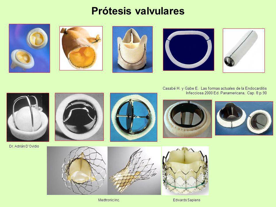 Prótesis valvulares Casabé H. y Gabe E. Las formas actuales de la Endocarditis Infecciosa.2000 Ed. Panamericana, Cap. 8:p.90.