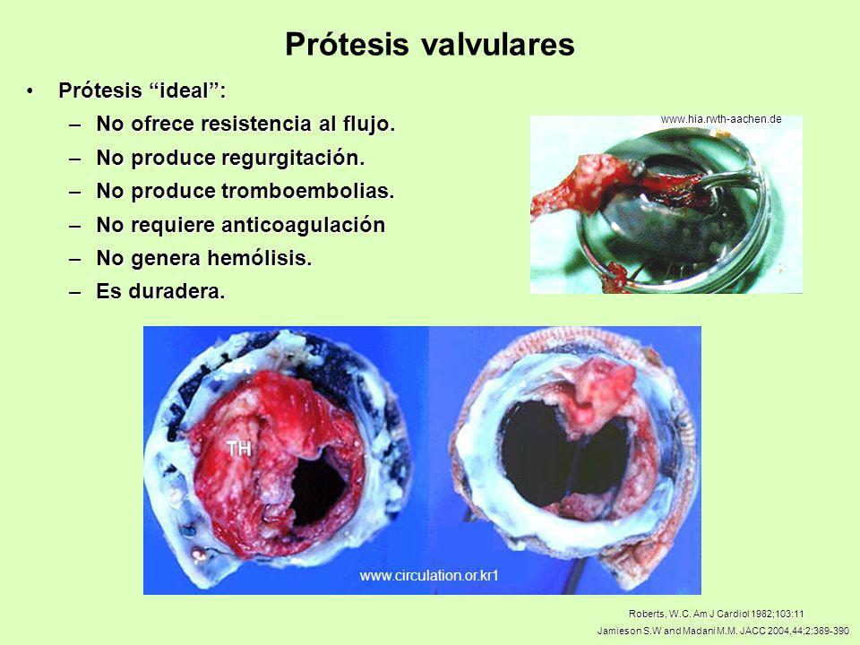 Prótesis valvulares Prótesis ideal : No ofrece resistencia al flujo.