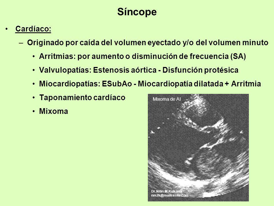 Síncope Cardíaco: Originado por caída del volumen eyectado y/o del volumen minuto. Arritmias: por aumento o disminución de frecuencia (SA)