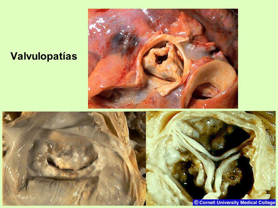 Valvulopatías