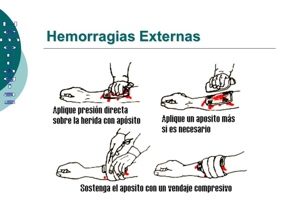 Hemorragias Externas Hemorragias