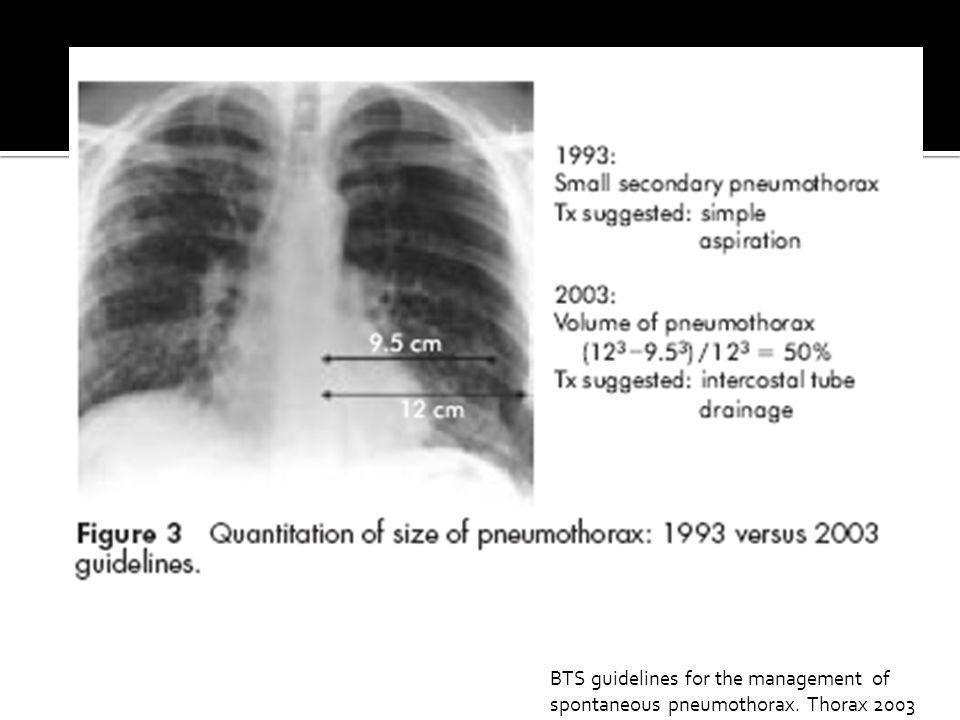 BTS guidelines for the management of spontaneous pneumothorax