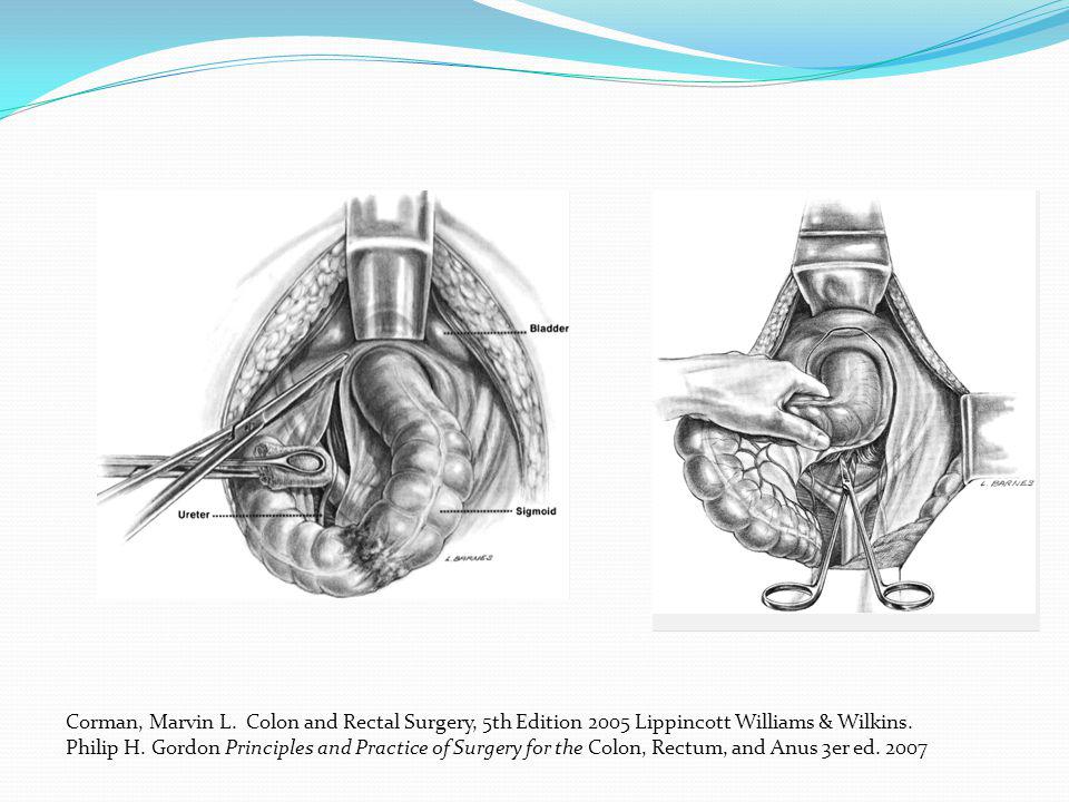 Corman, Marvin L. Colon and Rectal Surgery, 5th Edition 2005 Lippincott Williams & Wilkins.