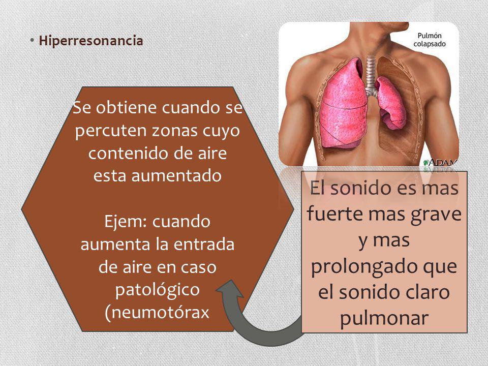 Ejem: cuando aumenta la entrada de aire en caso patológico (neumotórax