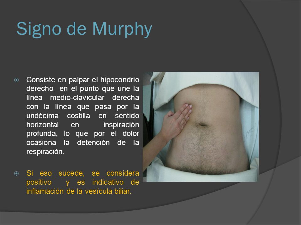 mano de signo de murphy