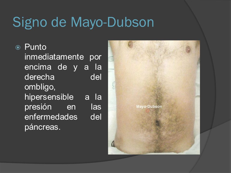 Signo de Mayo-Dubson Punto inmediatamente por encima de y a la derecha del ombligo, hipersensible a la presión en las enfermedades del páncreas.