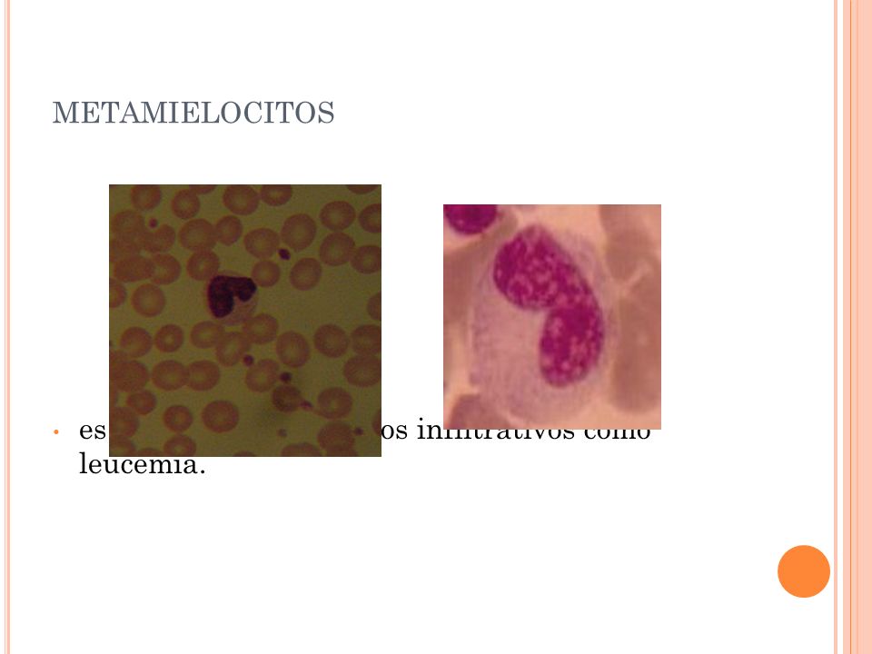 metamielocitos es indicativa de procesos infiltrativos como leucemia.