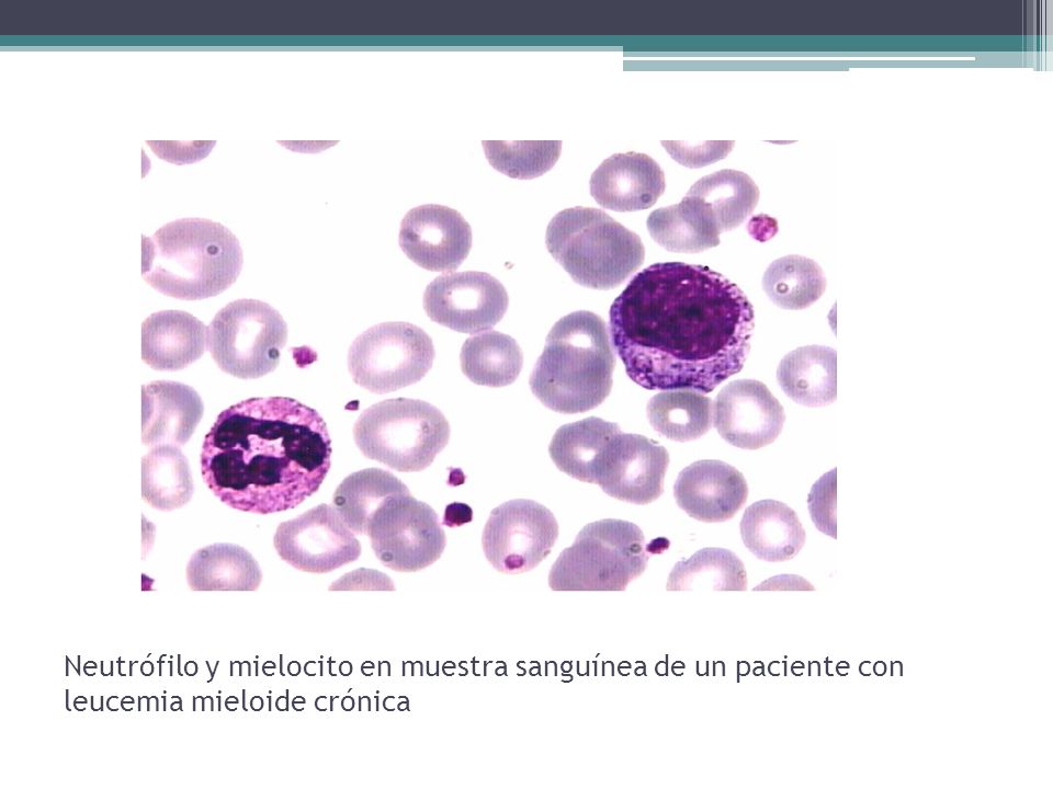 Neutrófilo y mielocito en muestra sanguínea de un paciente con leucemia mieloide crónica