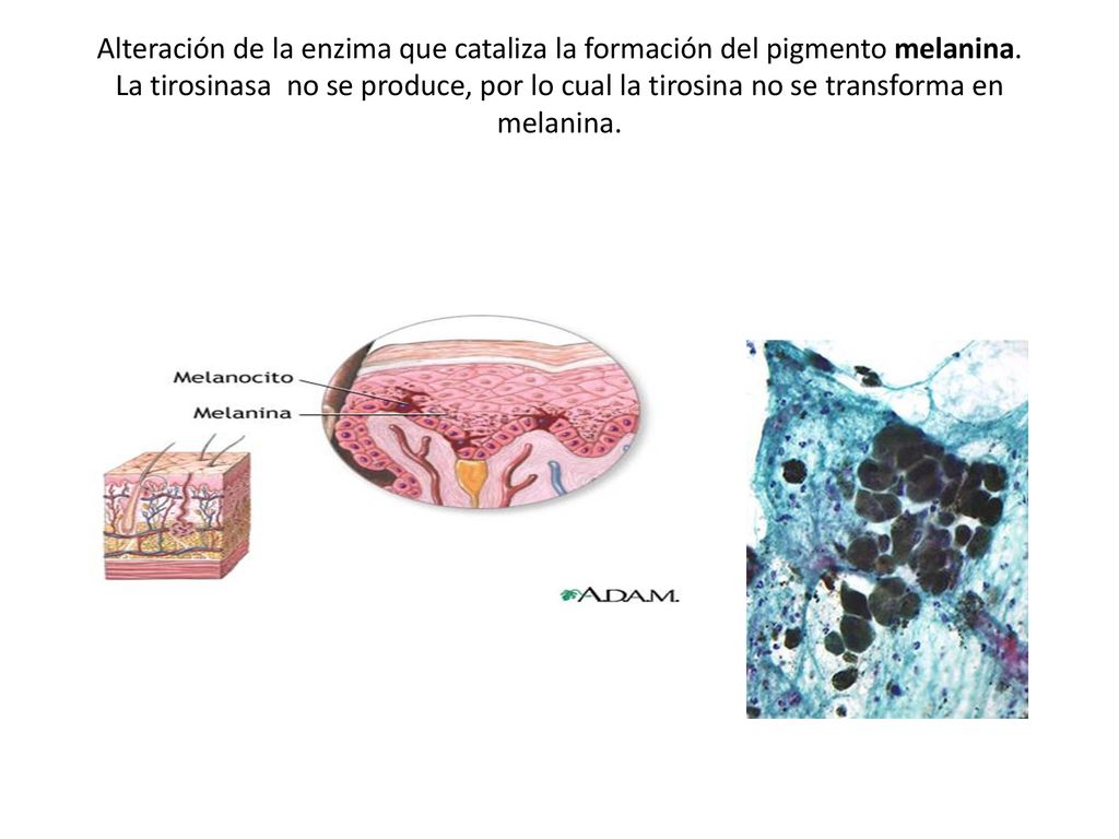 Alteración de la enzima que cataliza la formación del pigmento melanina.