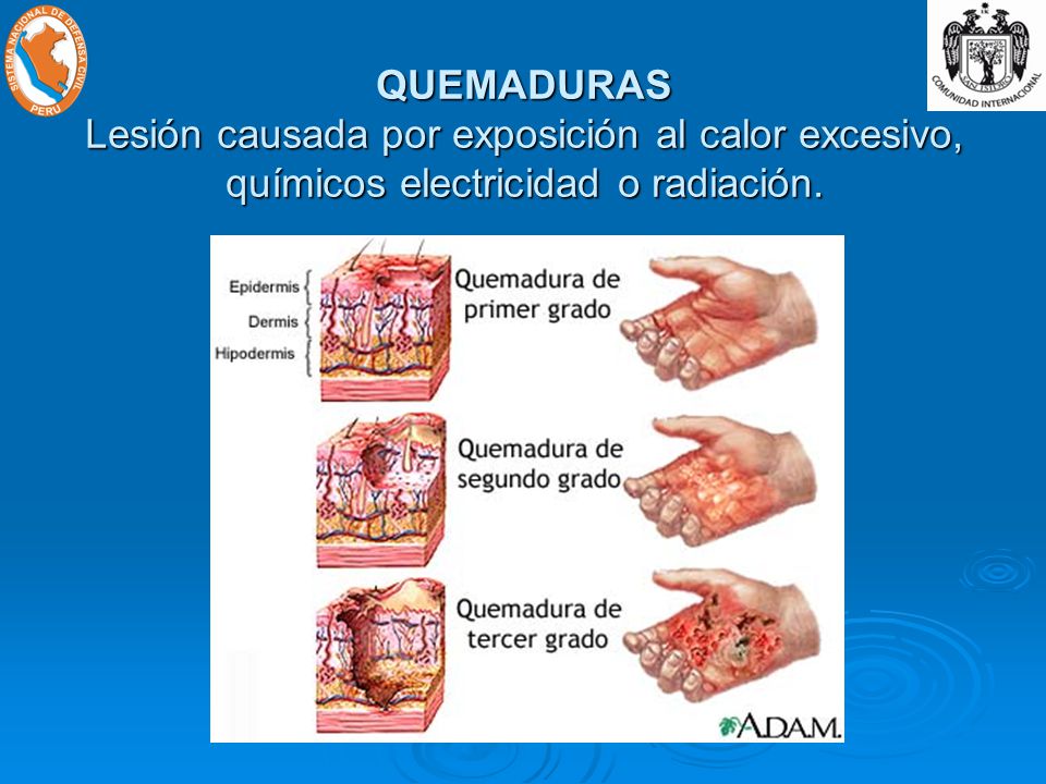 QUEMADURAS Lesión causada por exposición al calor excesivo, químicos electricidad o radiación.