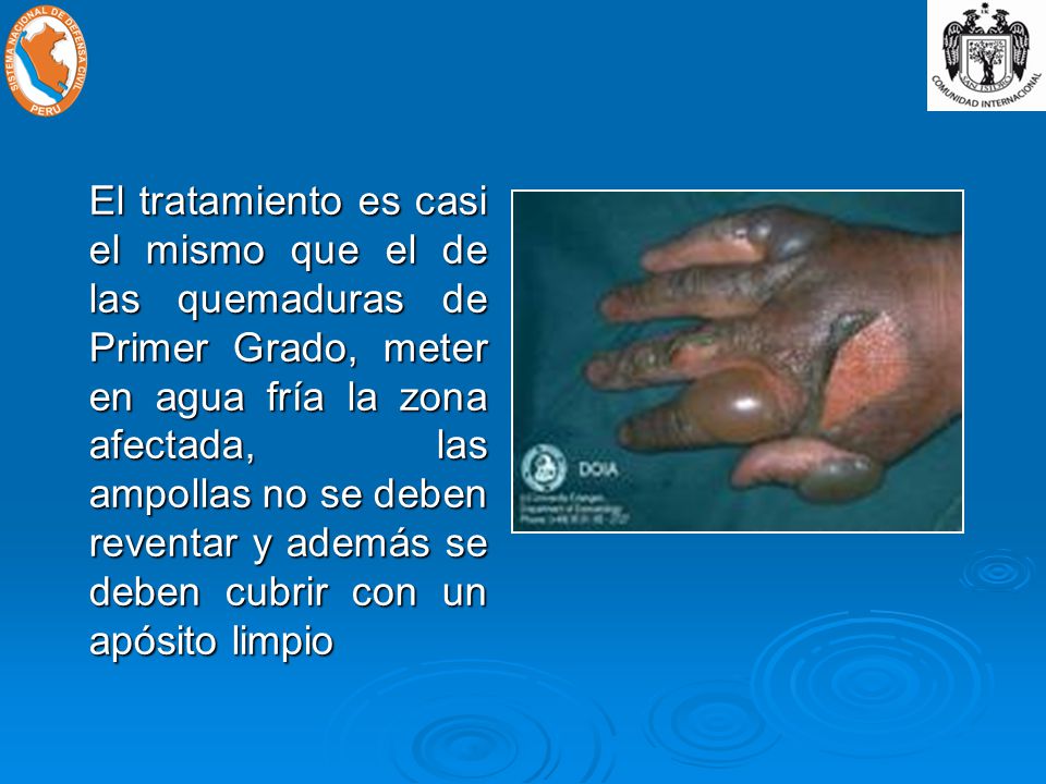El tratamiento es casi el mismo que el de las quemaduras de Primer Grado, meter en agua fría la zona afectada, las ampollas no se deben reventar y además se deben cubrir con un apósito limpio