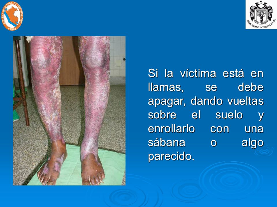 Si la víctima está en llamas, se debe apagar, dando vueltas sobre el suelo y enrollarlo con una sábana o algo parecido.
